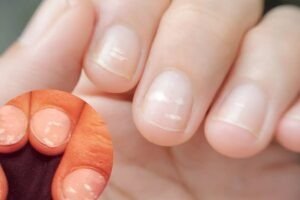 Découverte de solutions contre les taches blanches sur les ongles.