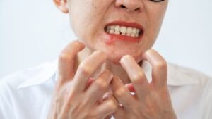 techniques et astuces beauté pour enlever un bouton de fièvre en une nuit.