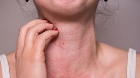 Gros plan sur le cou d'une femme montrant des boutons d'allergie au soleil