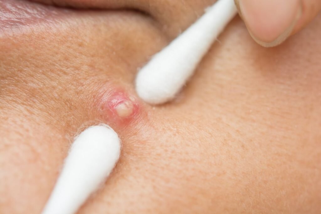 Utilisation de cotons-tiges pour traiter un bouton sur la peau